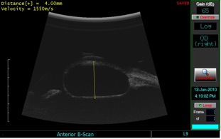 B-scan echography. caption below elaborates)